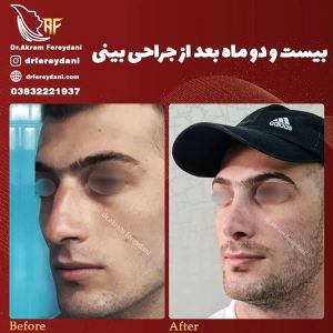 جراحی-بینی-99