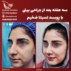 جراحی-بینی82