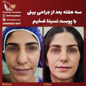 جراحی-بینی86