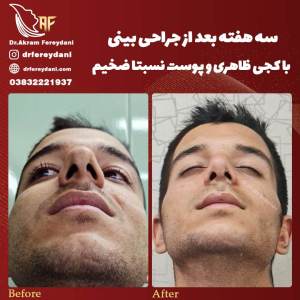جراحی-بینی90