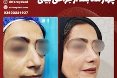 جراحی-بینی-137