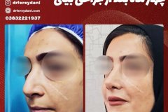 جراحی-بینی-138