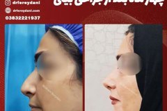 جراحی-بینی-139