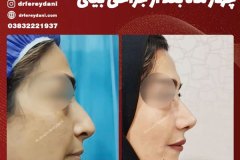 جراحی-بینی-140