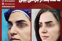جراحی-بینی-141