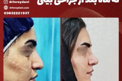 جراحی-بینی-142