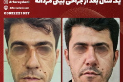 جراحی-بینی-144
