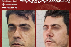 جراحی-بینی-145