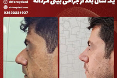 جراحی-بینی-146