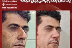 جراحی-بینی-147