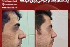 جراحی-بینی-148
