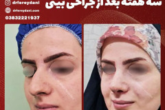 جراحی-بینی-149