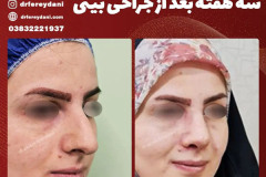 جراحی-بینی-150