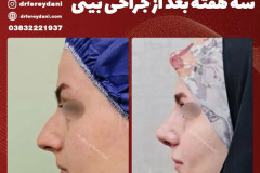 جراحی-بینی-151