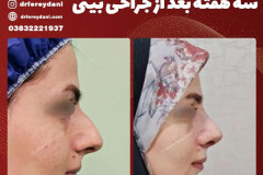 جراحی-بینی-152