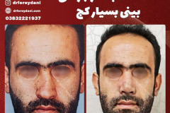 جراحی-بینی-153