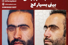 جراحی-بینی-154