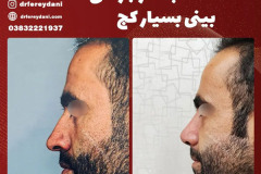 جراحی-بینی-155
