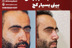 جراحی-بینی-156
