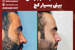 جراحی-بینی-157
