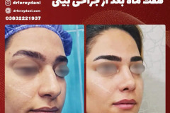 جراحی-بینی-158