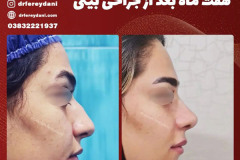 جراحی-بینی-159