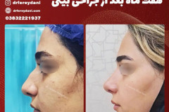 جراحی-بینی-160