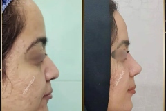 جراحی-بینی-161