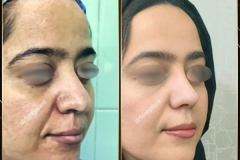 جراحی-بینی-162