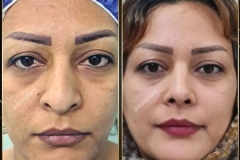 جراحی-بینی-163