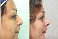 جراحی-بینی-164