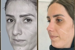 جراحی-بینی-165