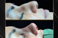 جراحی-بینی-167