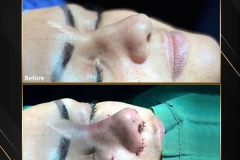 جراحی-بینی-168