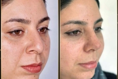 جراحی-بینی-169