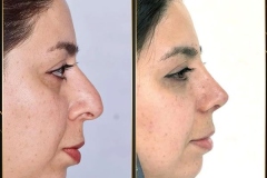 جراحی-بینی-170