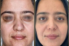 جراحی-بینی-171