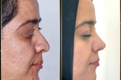 جراحی-بینی-172