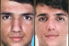 جراحی-بینی-173