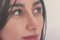 جراحی-بینی-175