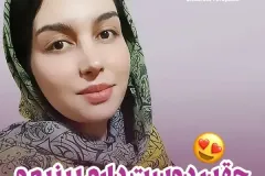 جراحی-بینی-177