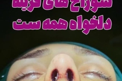 جراحی-بینی-178
