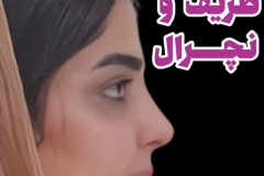 جراحی-بینی-180