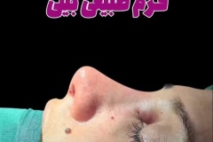 جراحی-بینی-181