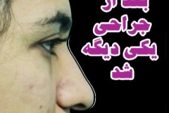 جراحی-بینی-182
