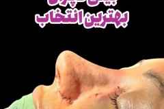 جراحی-بینی-183