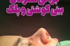 جراحی-بینی-185