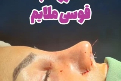 جراحی-بینی-188