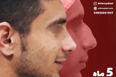 جراحی-بینی-2