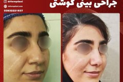 جراحی-بینی-20